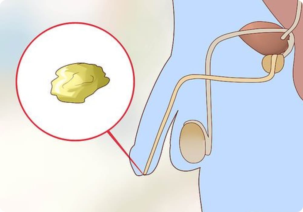 jenis penyakit kelamin lelaki