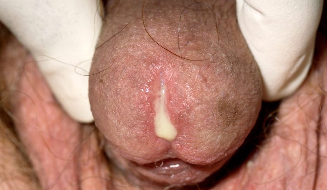 Penyakit Gonorrhea di Malaysia : Punca, Simptom & Rawatan