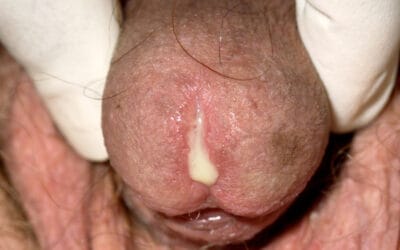 Penyakit Gonorrhea di Malaysia : Punca, Simptom & Rawatan