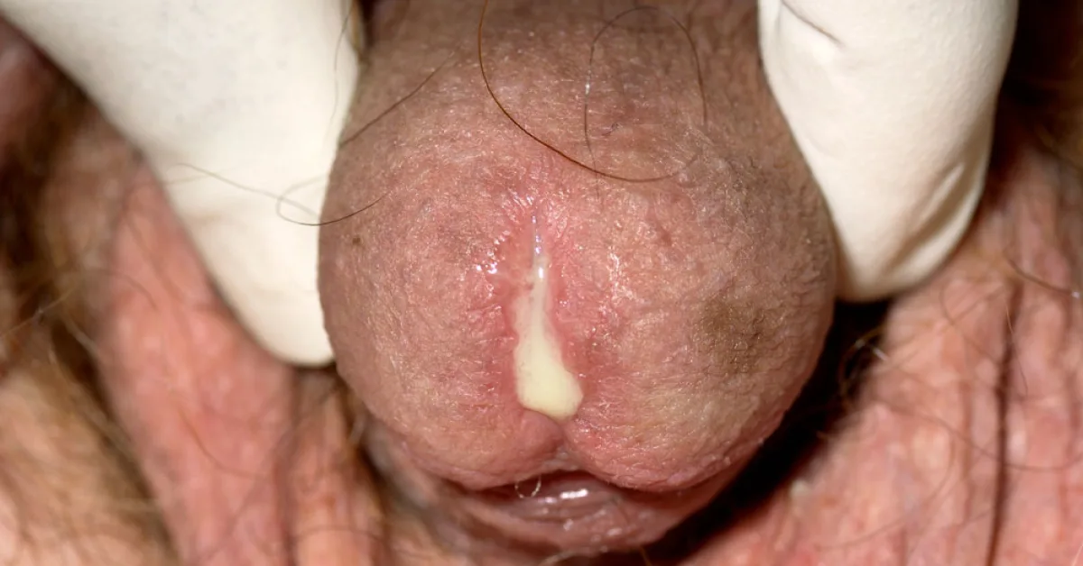 penyakit gonorrhea