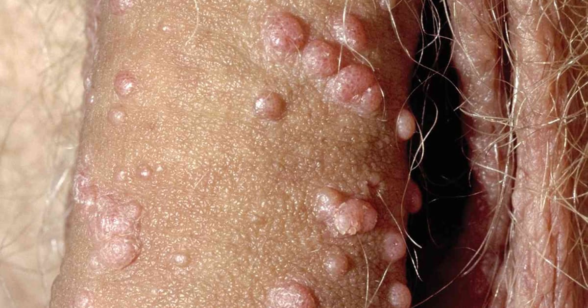 Mujarab-atau-mitos-miyak-lintah-belacak-dhab