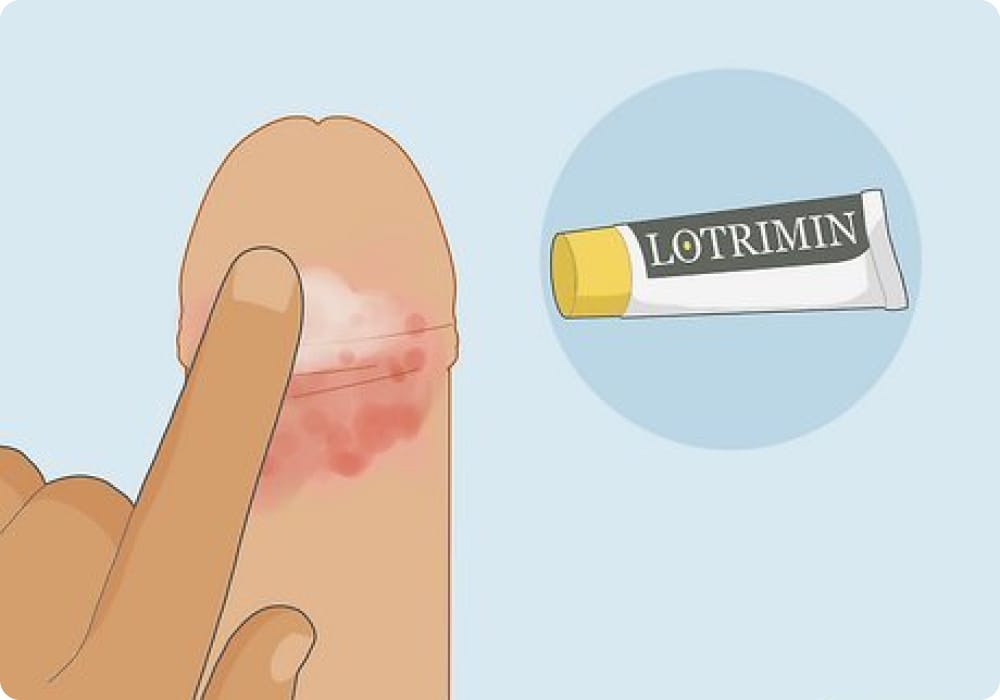 sakit kelamin lelaki