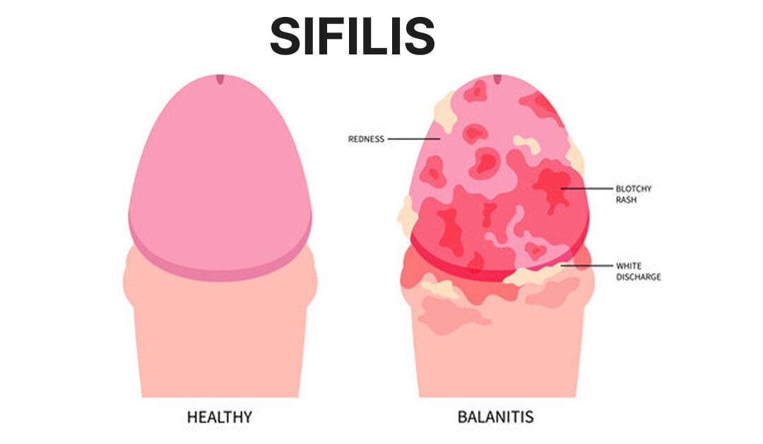 Pernah Seks Bebas? Awas! Ini Punca, Peringkat & Tanda Sifilis