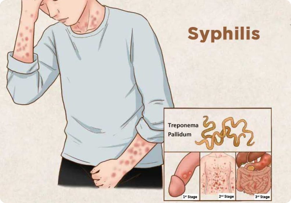 tanda tanda sifilis