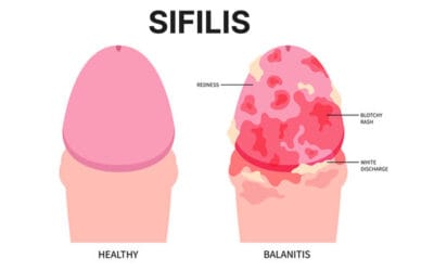 Pernah Seks Bebas? Awas! Ini Punca, Peringkat & Tanda Sifilis