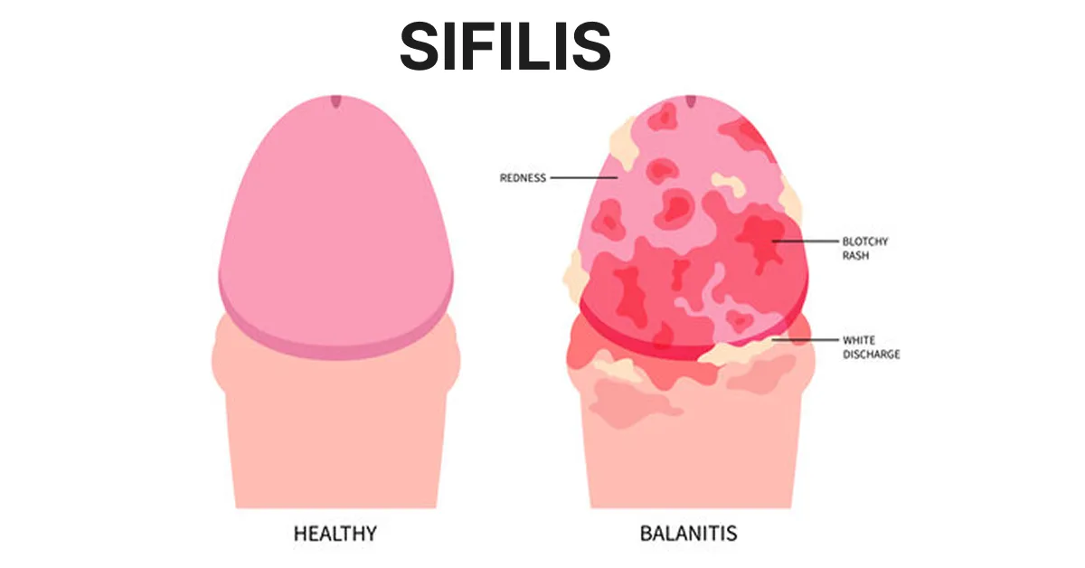 tanda tanda sifilis