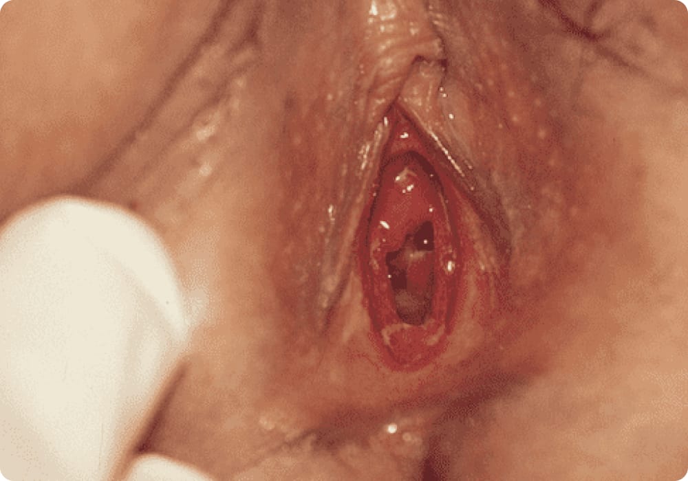 dijangkiti penyakit kelamin