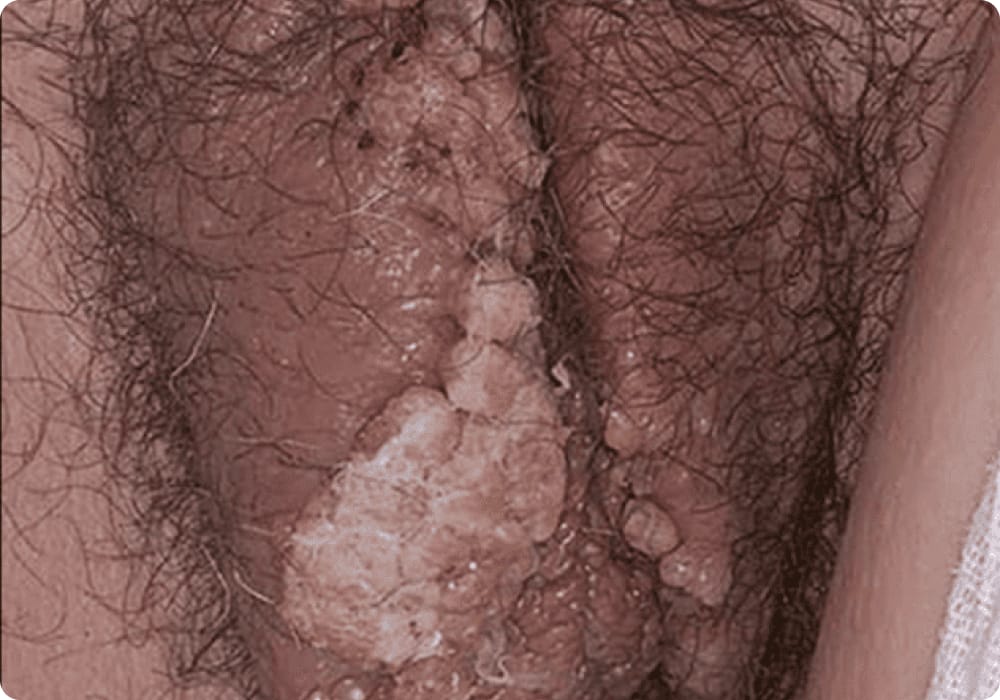 dijangkiti penyakit kelamin