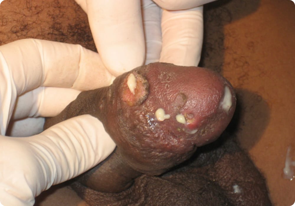 dijangkiti penyakit kelamin