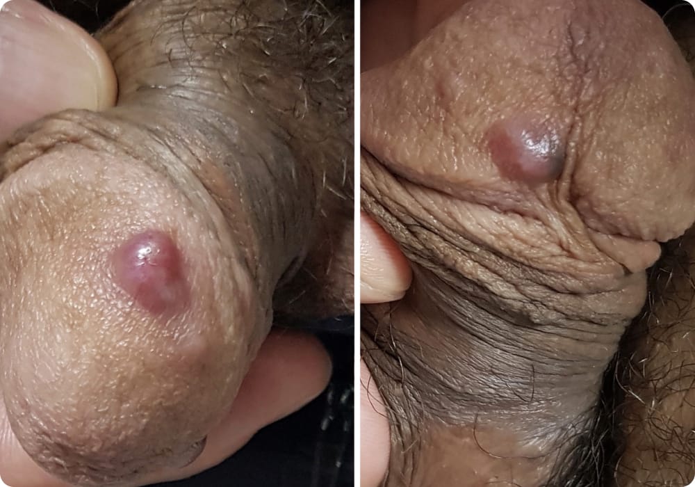 dijangkiti penyakit kelamin