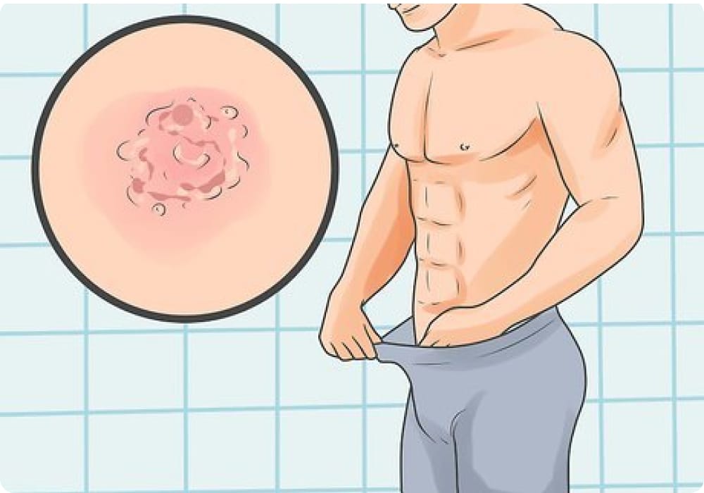 herpes dalam konteks malaysia