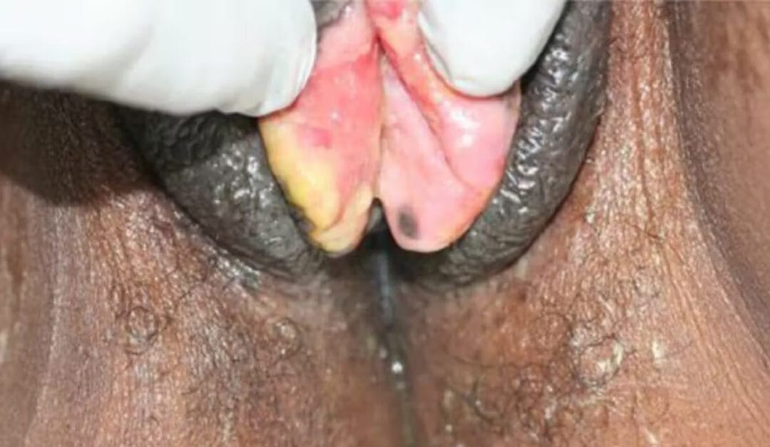 Herpes Dalam Konteks Malaysia : Meningkat atau Menurun?