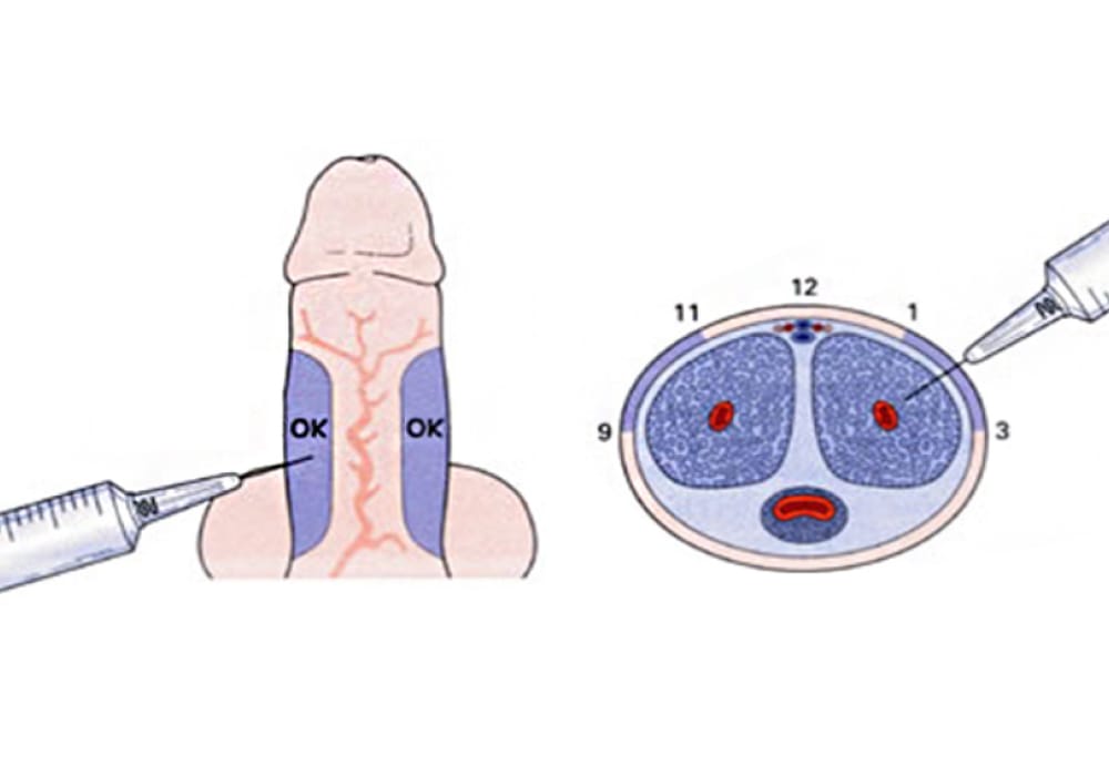 p shot treatment for men in malaysia